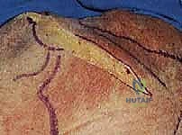 أسباب كسور الكتف