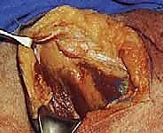 تشخيص كسور المفصل