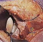 خطوات جراحة تثبيت الكتف