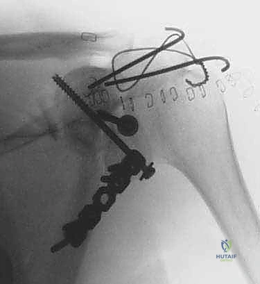 جراحة تثبيت كسور لوح الكتف داخل المفصل: دليل شامل للمرضى مع الأستاذ الدكتور محمد هطيف
