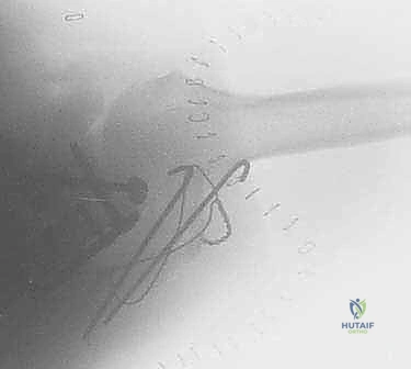 صورة توضيحية لـ جراحة تثبيت كسور لوح الكتف داخل المفصل: دليل شامل للمرضى مع الأستاذ الدكتور محمد هطيف