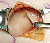 صورة توضيحية لـ جراحة تثبيت كسور لوح الكتف داخل المفصل: دليل شامل للمرضى مع الأستاذ الدكتور محمد هطيف