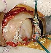 صورة توضيحية لـ جراحة تثبيت كسور لوح الكتف داخل المفصل: دليل شامل للمرضى مع الأستاذ الدكتور محمد هطيف