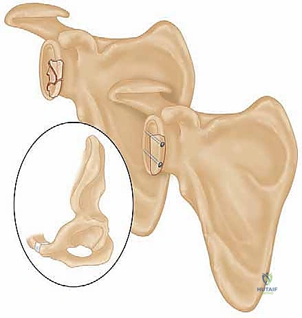 صورة توضيحية لـ جراحة تثبيت كسور لوح الكتف داخل المفصل: دليل شامل للمرضى مع الأستاذ الدكتور محمد هطيف