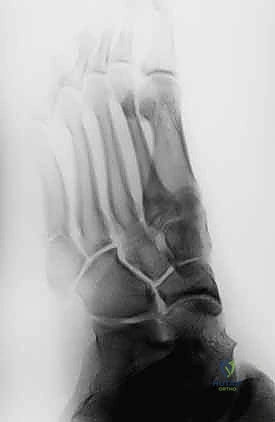 تورم وكدمات على الحافة الخارجية للقدم