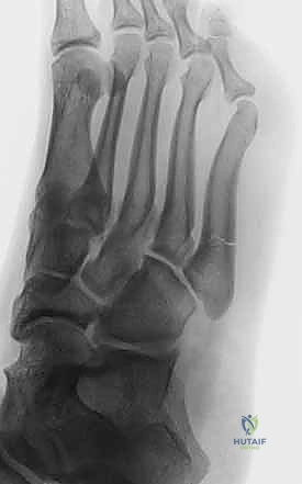 كسر جونز: دليل شامل للعلاج الجراحي بالمسامير الداخلية مع الأستاذ الدكتور محمد هطيف في صنعاء