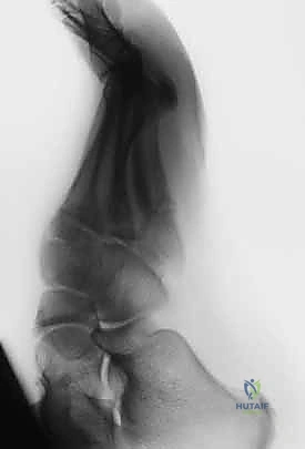 صورة مقطعية توضح تفاصيل الكسر في مشط القدم