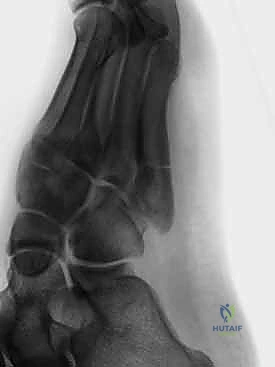 آلية حدوث التواء القدم المؤدي لكسر جونز