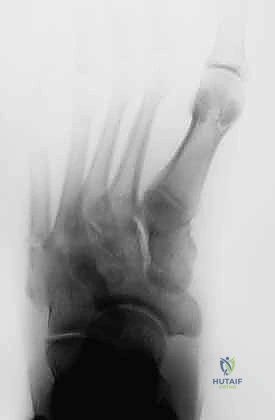 الأشعة السينية توضح موقع كسر جونز بدقة