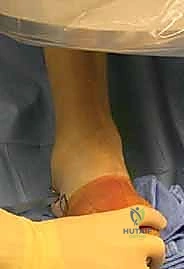 جلسة علاج طبيعي لتأهيل القدم بعد الالتئام