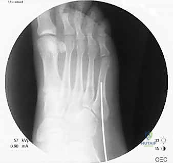 توضيح تشريحي لكسر جونز في مشط القدم