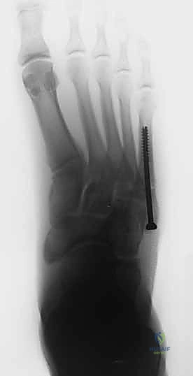 استخدام الأشعة السينية لتشخيص كسر جونز