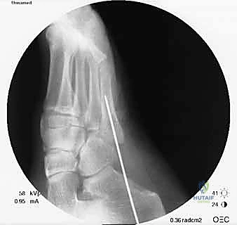 صورة شعاعية تظهر التئاماً تاماً للكسر بعد أشهر من الجراحة