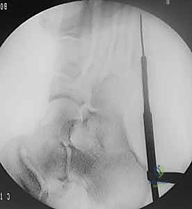 مقارنة بين القدم في الجبس والقدم بعد الجراحة