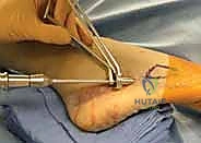 مقارنة بين أنواع كسور العظمة الخامسة لمشط القدم