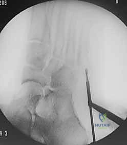 أهمية التوقف عن التدخين لضمان التئام العظام