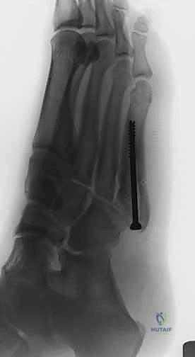 أطعمة غنية بالكالسيوم وفيتامين د المفيدة للعظام