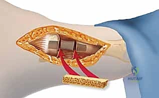 صورة توضيحية لـ كسر جونز: دليل شامل للعلاج الجراحي بالمسامير الداخلية مع الأستاذ الدكتور محمد هطيف في صنعاء