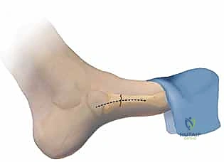 خطوات إدخال سلك التوجيه والمسمار تحت الأشعة