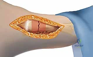 صورة توضيحية لـ كسر جونز: دليل شامل للعلاج الجراحي بالمسامير الداخلية مع الأستاذ الدكتور محمد هطيف في صنعاء