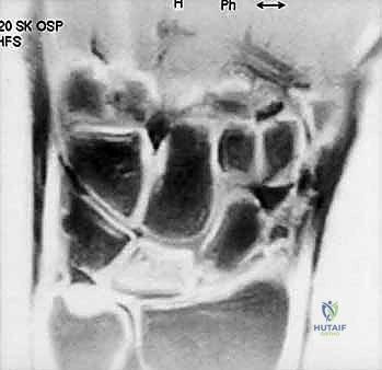 Illustration of negative ulnar variance - Dr. Mohammed Hutaif