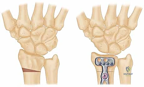 تشريح الرسغ والعظم الهلالي