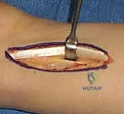 صورة طبية: عملية تقصير عظم الكعبرة لعلاج مرض كينبوك: دليل شامل للمرضى مع الأستاذ الدكتور محمد هطيف