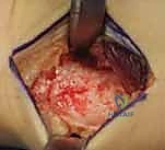 صورة طبية: عملية تقصير عظم الكعبرة لعلاج مرض كينبوك: دليل شامل للمرضى مع الأستاذ الدكتور محمد هطيف