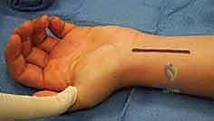 مراحل تطور مرض كينبوك