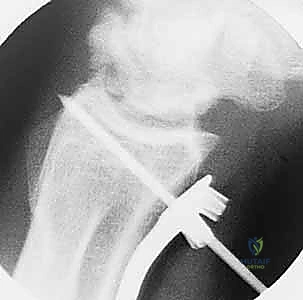 صورة طبية: عملية تقصير عظم الكعبرة لعلاج مرض كينبوك: دليل شامل للمرضى مع الأستاذ الدكتور محمد هطيف