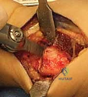 صورة توضيحية لـ عملية تقصير عظم الكعبرة لعلاج مرض كينبوك: دليل شامل للمرضى مع الأستاذ الدكتور محمد هطيف