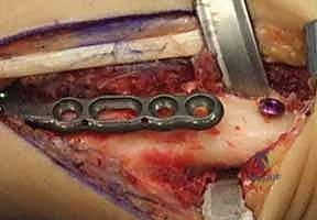 صورة توضيحية لـ عملية تقصير عظم الكعبرة لعلاج مرض كينبوك: دليل شامل للمرضى مع الأستاذ الدكتور محمد هطيف