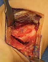 صورة طبية: عملية تقصير عظم الكعبرة لعلاج مرض كينبوك: دليل شامل للمرضى مع الأستاذ الدكتور محمد هطيف