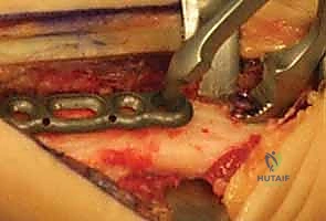 صورة طبية: عملية تقصير عظم الكعبرة لعلاج مرض كينبوك: دليل شامل للمرضى مع الأستاذ الدكتور محمد هطيف