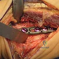 Arab Ortho Board MCQs - Part 6