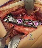 Radial Shortening Osteotomy for Kienböck Disease: An Intraoperative Masterclass