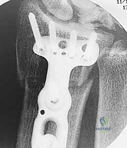 صورة توضيحية لـ عملية تقصير عظم الكعبرة لعلاج مرض كينبوك: دليل شامل للمرضى مع الأستاذ الدكتور محمد هطيف