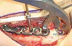 صورة طبية: عملية تقصير عظم الكعبرة لعلاج مرض كينبوك: دليل شامل للمرضى مع الأستاذ الدكتور محمد هطيف