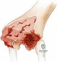 صورة توضيحية لـ استبدال الفخذ البعيد في مراجعة مفصل الركبة الكلي: دليل شامل للمرضى مع الأستاذ الدكتور محمد هطيف