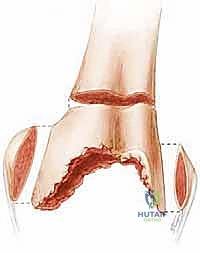 صورة توضيحية لـ استبدال الفخذ البعيد في مراجعة مفصل الركبة الكلي: دليل شامل للمرضى مع الأستاذ الدكتور محمد هطيف