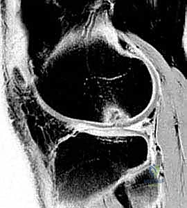 نجاح عملية الركبة بالمنظار في صنعاء