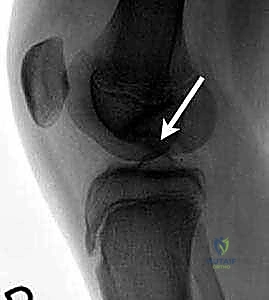 Illustration of drilling of osteochondritis - Dr. Mohammed Hutaif
