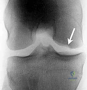 أفضل دكتور عظام في اليمن دكتور هطيف