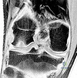 إعادة التأهيل بعد جراحة غضروف الركبة
