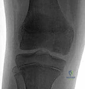 تقنية الحفر لتحفيز التروية الدموية