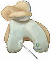 صورة توضيحية لـ التهاب العظم والغضروف السالخ في الركبة: دليل شامل للتشخيص والعلاج بالمنظار مع الأستاذ الدكتور محمد هطيف