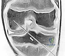 منظار الركبة المتقدم في اليمن