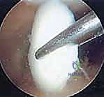 تثبيت الغضروف السالخ بالمنظار