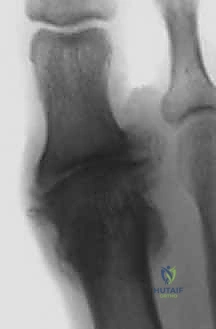 الأستاذ الدكتور محمد هطيف أثناء تقييم حالة إبهام القدم المتيبس