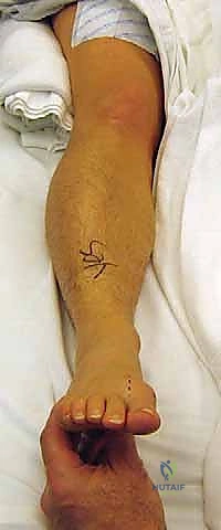 الأشعة السينية توضح تآكل الغضروف في المفصل المشطي السلامي الأول